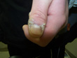 mouldy_thumb